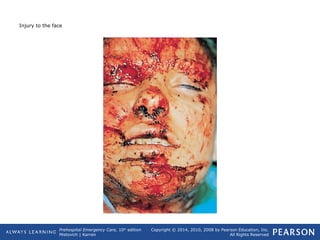 Prehospital Emergency Care, 10th
edition
Mistovich | Karren
Copyright © 2014, 2010, 2008 by Pearson Education, Inc.
All Rights Reserved
Injury to the face
 
