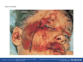 Prehospital Emergency Care, 10th
edition
Mistovich | Karren
Copyright © 2014, 2010, 2008 by Pearson Education, Inc.
All Rights Reserved
Injury to the face
 