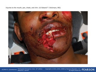 Prehospital Emergency Care, 10th
edition
Mistovich | Karren
Copyright © 2014, 2010, 2008 by Pearson Education, Inc.
All Rights Reserved
Injuries to the mouth, jaw, cheek, and chin. (© Edward T. Dickinson, MD)
 