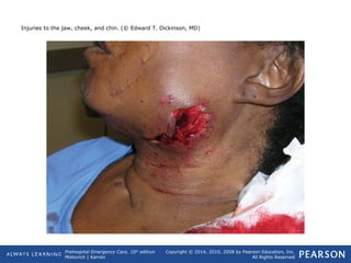 Prehospital Emergency Care, 10th
edition
Mistovich | Karren
Copyright © 2014, 2010, 2008 by Pearson Education, Inc.
All Rights Reserved
Injuries to the jaw, cheek, and chin. (© Edward T. Dickinson, MD)
 