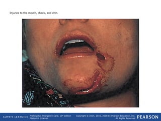 Prehospital Emergency Care, 10th
edition
Mistovich | Karren
Copyright © 2014, 2010, 2008 by Pearson Education, Inc.
All Rights Reserved
Injuries to the mouth, cheek, and chin.
 