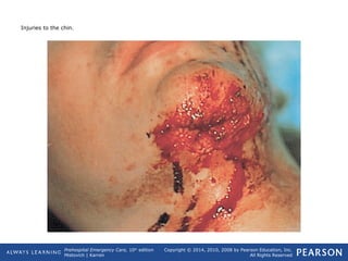 Prehospital Emergency Care, 10th
edition
Mistovich | Karren
Copyright © 2014, 2010, 2008 by Pearson Education, Inc.
All Rights Reserved
Injuries to the chin.
 