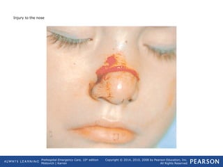 Prehospital Emergency Care, 10th
edition
Mistovich | Karren
Copyright © 2014, 2010, 2008 by Pearson Education, Inc.
All Rights Reserved
Injury to the nose
 