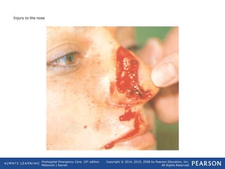 Prehospital Emergency Care, 10th
edition
Mistovich | Karren
Copyright © 2014, 2010, 2008 by Pearson Education, Inc.
All Rights Reserved
Injury to the nose
 
