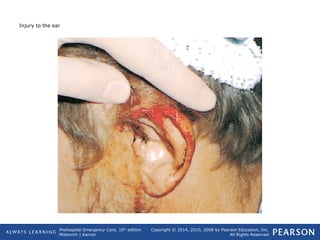 Prehospital Emergency Care, 10th
edition
Mistovich | Karren
Copyright © 2014, 2010, 2008 by Pearson Education, Inc.
All Rights Reserved
Injury to the ear
 