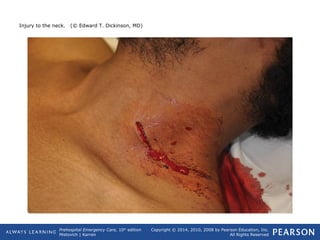 Prehospital Emergency Care, 10th
edition
Mistovich | Karren
Copyright © 2014, 2010, 2008 by Pearson Education, Inc.
All Rights Reserved
Injury to the neck. (© Edward T. Dickinson, MD)
 