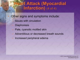 Heart Attack (Myocardial
Infarction) (4 of 4)
• Other signs and symptoms include:
– Issues with circulation
– Diaphoresis
– Pale, cyanotic mottled skin
– Adventitious or decreased breath sounds
– Increased peripheral edema
 