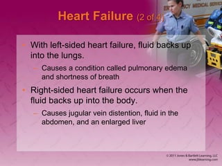 Heart Failure (2 of 4)
• With left-sided heart failure, fluid backs up
into the lungs.
– Causes a condition called pulmonary edema
and shortness of breath
• Right-sided heart failure occurs when the
fluid backs up into the body.
– Causes jugular vein distention, fluid in the
abdomen, and an enlarged liver
 