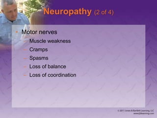 Neuropathy (2 of 4)
• Motor nerves
– Muscle weakness
– Cramps
– Spasms
– Loss of balance
– Loss of coordination
 