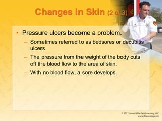 Changes in Skin (2 of 3)
• Pressure ulcers become a problem.
– Sometimes referred to as bedsores or decubitis
ulcers
– The pressure from the weight of the body cuts
off the blood flow to the area of skin.
– With no blood flow, a sore develops.
 
