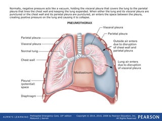 Prehospital Emergency Care, 10th
edition
Mistovich | Karren
Copyright © 2014, 2010, 2008 by Pearson Education, Inc.
All Rights Reserved
Normally, negative pressure acts like a vacuum, holding the visceral pleura that covers the lung to the parietal
pleura that lines the chest wall and keeping the lung expanded. When either the lung and its visceral pleura are
punctured or the chest wall and its parietal pleura are punctured, air enters the space between the pleura,
creating positive pressure on the lung and causing it to collapse.
 