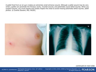 Prehospital Emergency Care, 10th
edition
Mistovich | Karren
Copyright © 2014, 2010, 2008 by Pearson Education, Inc.
All Rights Reserved
A pellet fired from an air gun creates an extremely small entrance wound. Although a pellet wound may be very
small, a pellet can penetrate the thoracic cavity, ricochet around, and potentially cause lethal injuries. When you
suspect trauma, you must expose and closely inspect the chest to avoid missing potentially lethal injuries. (Both
photos: © Charles Stewart, MD, FACEP)
continued on next slide
 