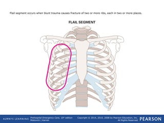 Prehospital Emergency Care, 10th
edition
Mistovich | Karren
Copyright © 2014, 2010, 2008 by Pearson Education, Inc.
All Rights Reserved
Flail segment occurs when blunt trauma causes fracture of two or more ribs, each in two or more places.
 