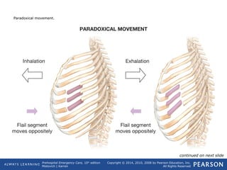 Prehospital Emergency Care, 10th
edition
Mistovich | Karren
Copyright © 2014, 2010, 2008 by Pearson Education, Inc.
All Rights Reserved
Paradoxical movement.
continued on next slide
 