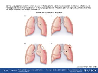 Prehospital Emergency Care, 10th
edition
Mistovich | Karren
Copyright © 2014, 2010, 2008 by Pearson Education, Inc.
All Rights Reserved
Normal versus paradoxical movement caused by flail segment. (a) Normal inhalation. (b) Normal exhalation. (c)
Flail segment drawn inward as the rest of the lung expands with inhalation. (d) Flail segment pushed outward as
the rest of the lung contracts with exhalation.
continued on next slide
 