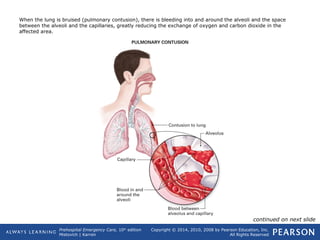 Prehospital Emergency Care, 10th
edition
Mistovich | Karren
Copyright © 2014, 2010, 2008 by Pearson Education, Inc.
All Rights Reserved
When the lung is bruised (pulmonary contusion), there is bleeding into and around the alveoli and the space
between the alveoli and the capillaries, greatly reducing the exchange of oxygen and carbon dioxide in the
affected area.
continued on next slide
 