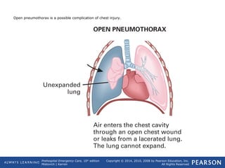 Prehospital Emergency Care, 10th
edition
Mistovich | Karren
Copyright © 2014, 2010, 2008 by Pearson Education, Inc.
All Rights Reserved
Open pneumothorax is a possible complication of chest injury.
 