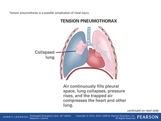 Prehospital Emergency Care, 10th
edition
Mistovich | Karren
Copyright © 2014, 2010, 2008 by Pearson Education, Inc.
All Rights Reserved
Tension pneumothorax is a possible complication of chest injury.
continued on next slide
 