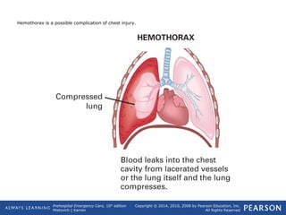 Prehospital Emergency Care, 10th
edition
Mistovich | Karren
Copyright © 2014, 2010, 2008 by Pearson Education, Inc.
All Rights Reserved
Hemothorax is a possible complication of chest injury.
 