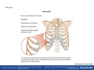 Prehospital Emergency Care, 10th
edition
Mistovich | Karren
Copyright © 2014, 2010, 2008 by Pearson Education, Inc.
All Rights Reserved
Rib injury.
continued on next slide
 