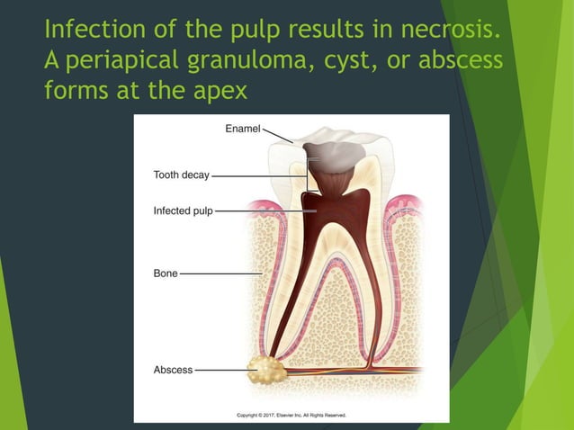Skin Abscess Pulp Chapter 35: Interpretation of Trauma, Pulpal Lesions, and Periapical ...