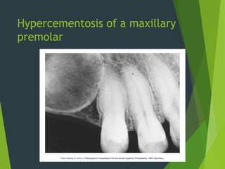 Hypercementosis Radiographic Chapter 35: Interpretation of Trauma, Pulpal Lesions, and Periapical ...