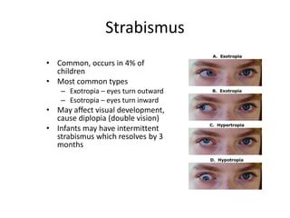 Chapter 39 Nursing Care of the Child with a Disorder of the Eyes or ...