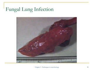Fungal Lung Infection

Chapter 3 : Techniques in microbiology

38

 