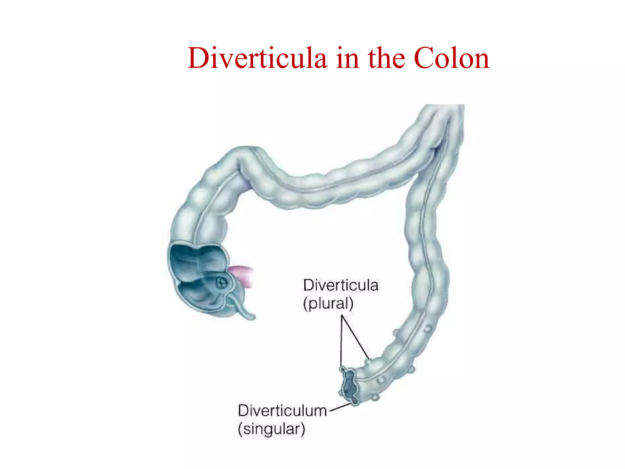 Diverticula in the Colon 