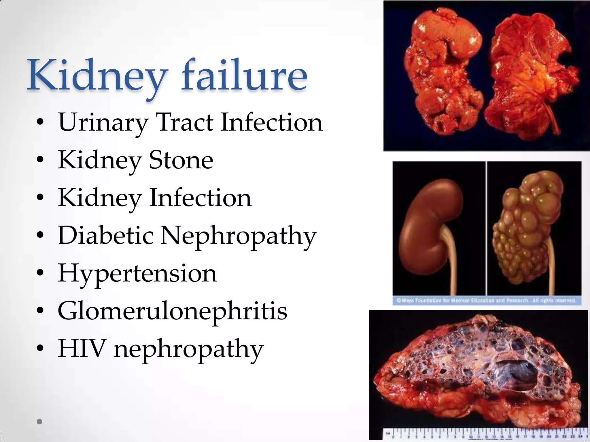 Kidney failure
•   Urinary Tract Infection
•   Kidney Stone
•   Kidney Infection
•   Diabetic Nephropathy
•   Hypertension
•   Glomerulonephritis
•   HIV nephropathy
 