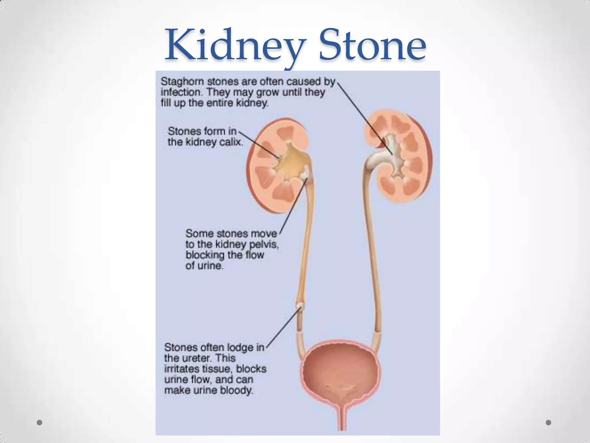 Kidney Stone
 