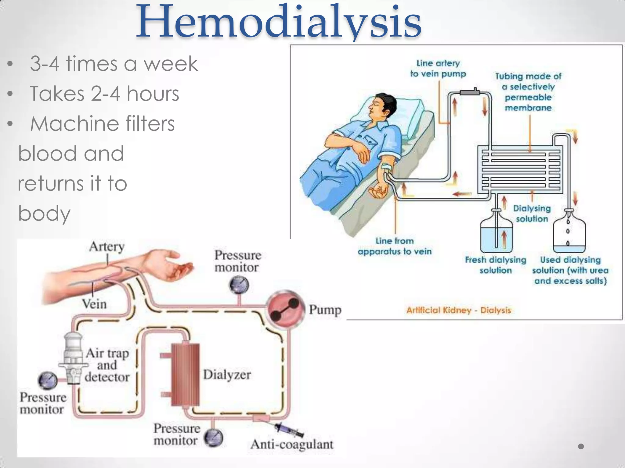 Hemodialysis
• 3-4 times a week
• Takes 2-4 hours
• Machine filters
 blood and
 returns it to
 body
 