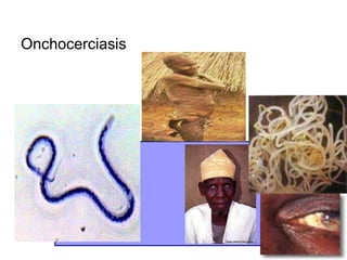 Onchocerciasis
 