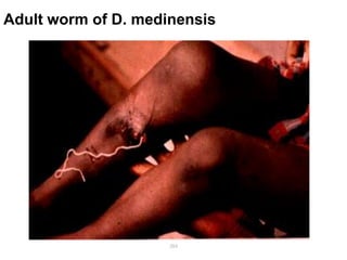 Adult worm of D. medinensis
284
 