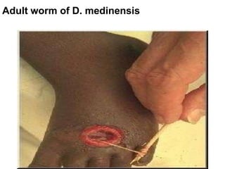 Adult worm of D. medinensis
285
 