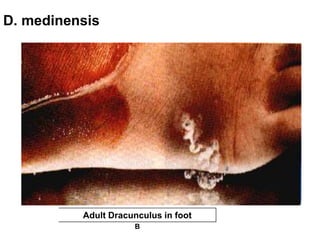 D. medinensis
288
Adult Dracunculus in foot
B
 