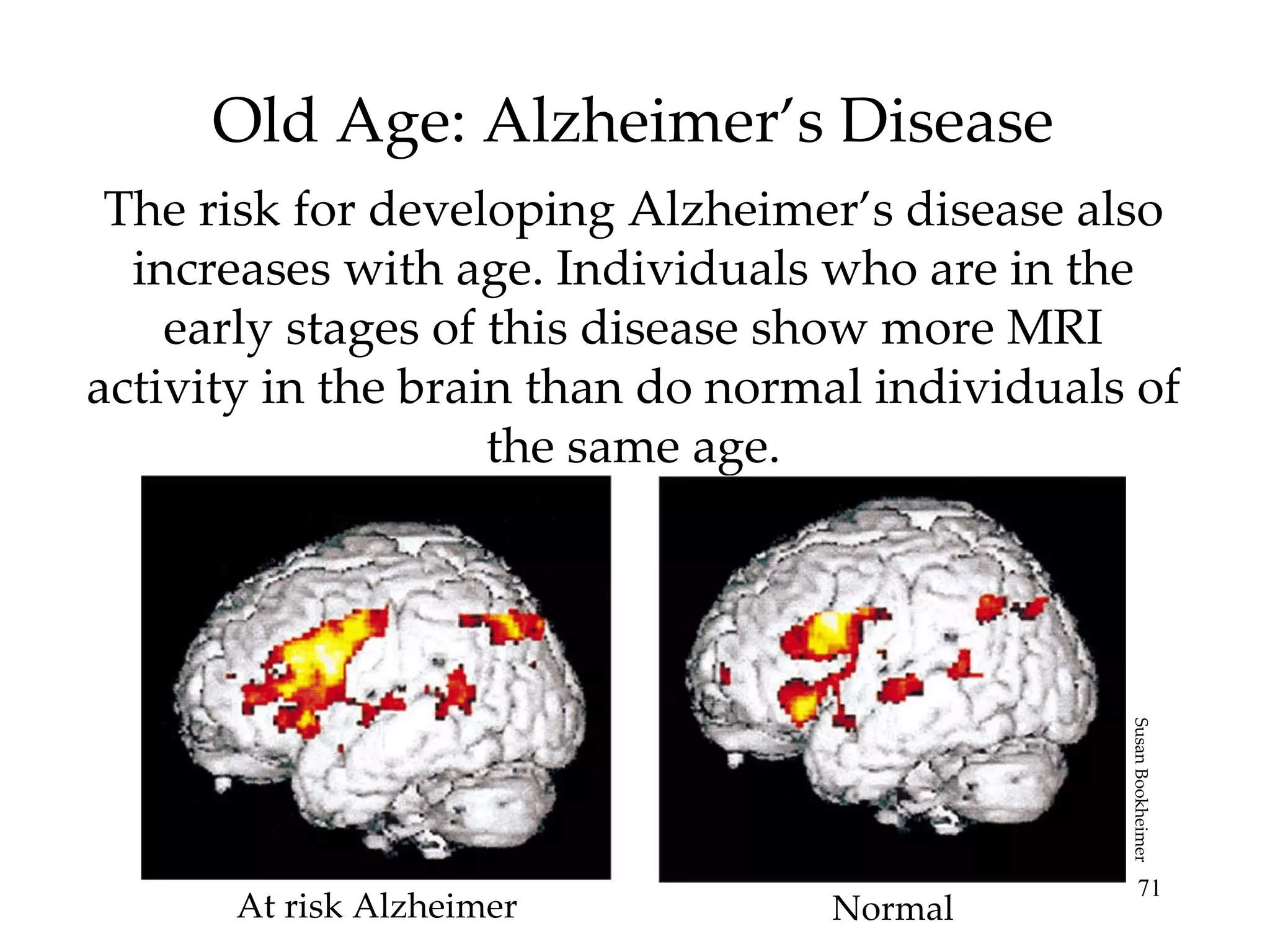 Old Age: Alzheimer’s Disease The risk for developing Alzheimer’s disease also increases with age. Individuals who are in the early stages of this disease show more MRI activity in the brain than do normal individuals of the same age. At risk Alzheimer Normal Susan Bookheimer 