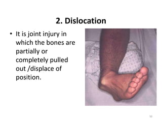 2. Dislocation
• It is joint injury in
which the bones are
partially or
completely pulled
out /displace of
position.
50
 