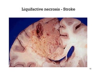 Liquifactive necrosis - Stroke




                                 10
 