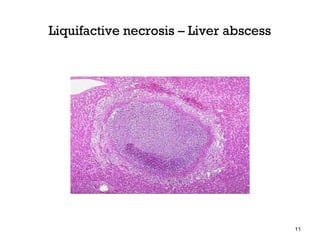Liquifactive necrosis – Liver abscess




                                        11
 