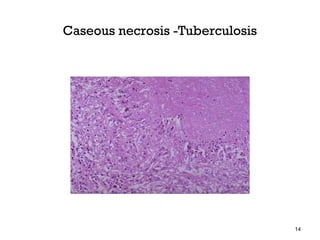 Caseous necrosis -Tuberculosis




                                 14
 