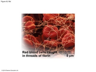 Figure 43.18b
Red blood cells caught
in threads of fibrin 5 µm
© 2018 Pearson Education Ltd.
 