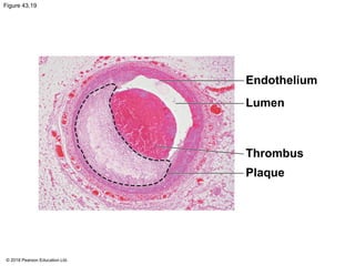 Figure 43.19
Endothelium
Lumen
Thrombus
Plaque
© 2018 Pearson Education Ltd.
 