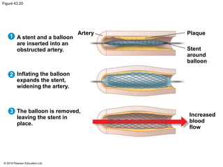 Figure 43.20
A stent and a balloon
are inserted into an
obstructed artery.
Artery Plaque
Stent
around
balloon
Inflating the balloon
expands the stent,
widening the artery.
The balloon is removed,
leaving the stent in
place.
Increased
blood
flow
1
2
3
© 2018 Pearson Education Ltd.
 