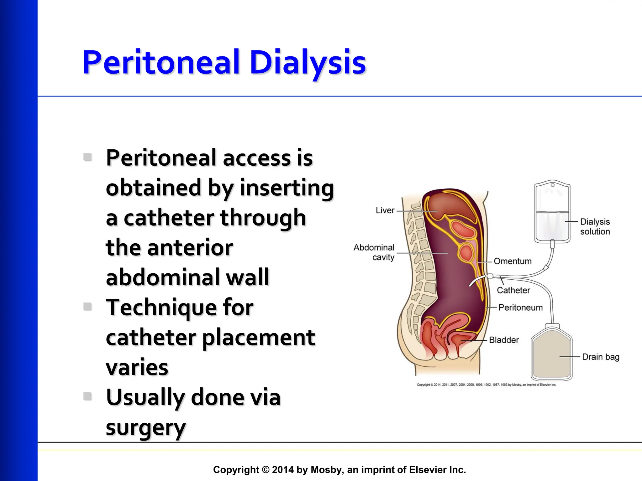 Copyright © 2014 by Mosby, an imprint of Elsevier Inc.
Peritoneal Dialysis
 Peritoneal access is
obtained by inserting
a catheter through
the anterior
abdominal wall
 Technique for
catheter placement
varies
 Usually done via
surgery
 