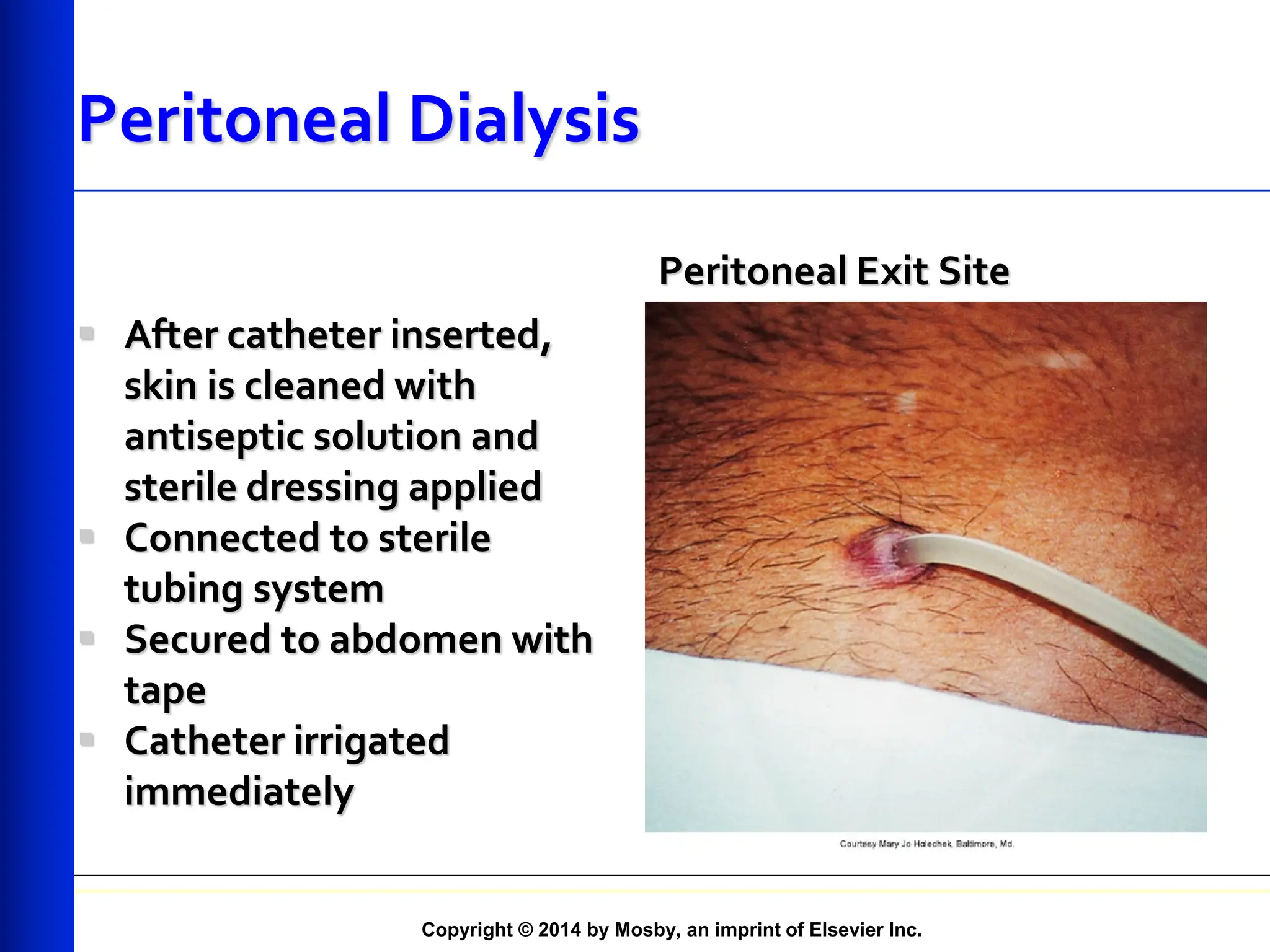 Copyright © 2014 by Mosby, an imprint of Elsevier Inc.
Peritoneal Dialysis
 After catheter inserted,
skin is cleaned with
antiseptic solution and
sterile dressing applied
 Connected to sterile
tubing system
 Secured to abdomen with
tape
 Catheter irrigated
immediately
Peritoneal Exit Site
 