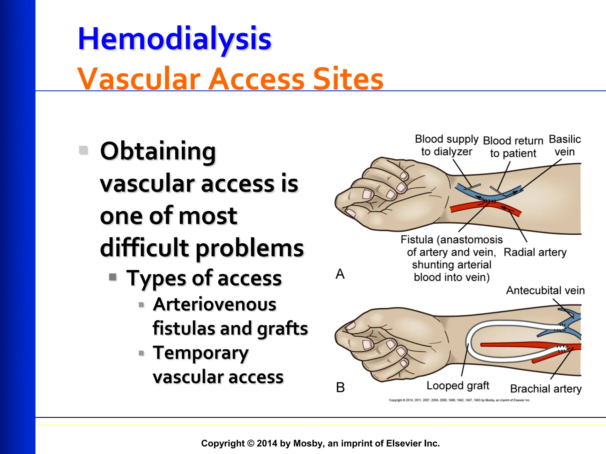 Copyright © 2014 by Mosby, an imprint of Elsevier Inc.
Hemodialysis
Vascular Access Sites
 Obtaining
vascular access is
one of most
difficult problems
 Types of access
 Arteriovenous
fistulas and grafts
 Temporary
vascular access
 