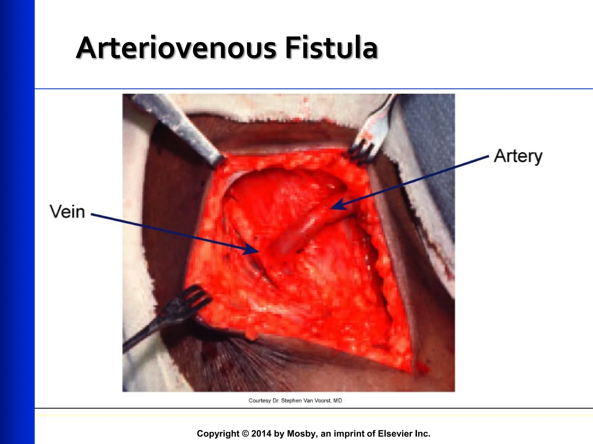 Copyright © 2014 by Mosby, an imprint of Elsevier Inc.
Arteriovenous Fistula
 