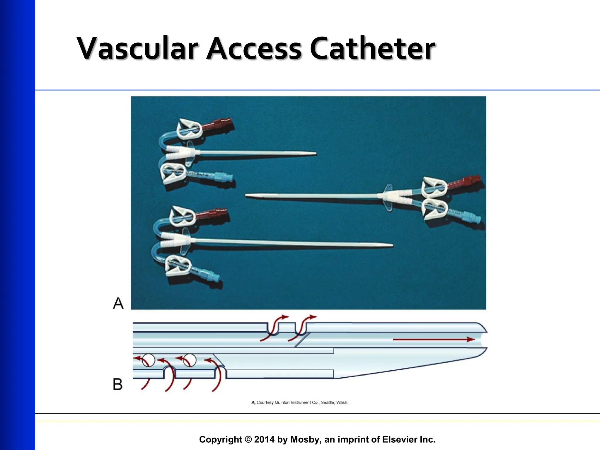 Copyright © 2014 by Mosby, an imprint of Elsevier Inc.
Vascular Access Catheter
 