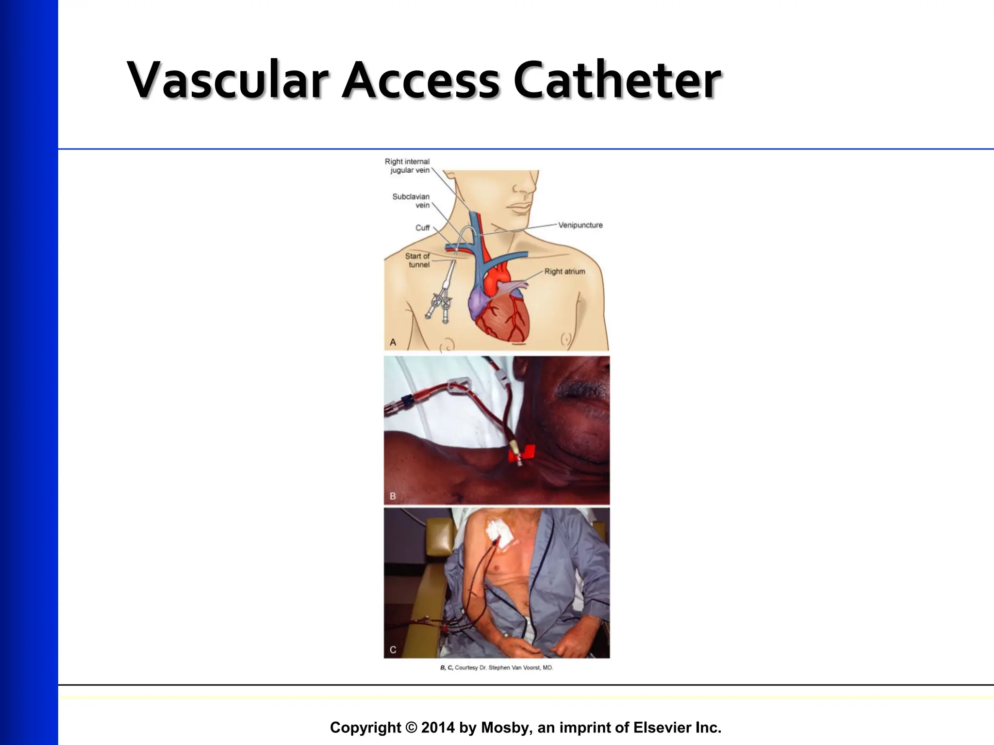Copyright © 2014 by Mosby, an imprint of Elsevier Inc.
Vascular Access Catheter
 